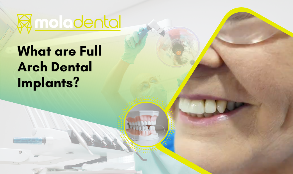 What are Full Arch Dental Implants?