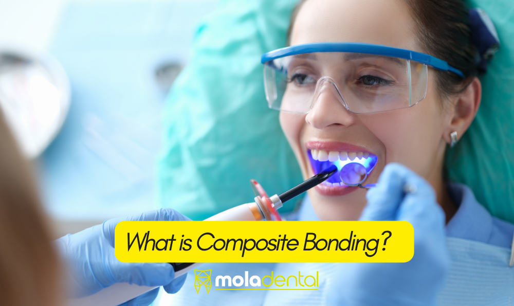 What is composite bonding?